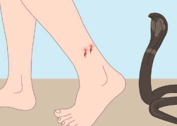 Jharkhand sub-divisional hospital proves saviour of Bihar snake bite victim